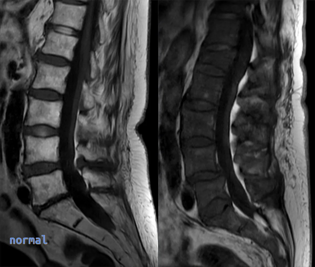 Polycythemia vera – Lumbar spine MRI (T1, sagittal): normal bright fatty marrow (left) versus diffusely dark, hypercellular marrow in polycythemia vera (right)