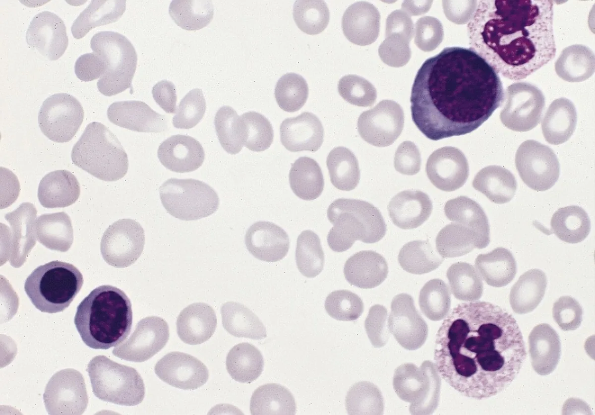 Polycythemia vera – Blood smear in late-stage polycythemia vera (myeloid metaplasia): teardrop cells, nucleated red cell precursors and granulocytes
