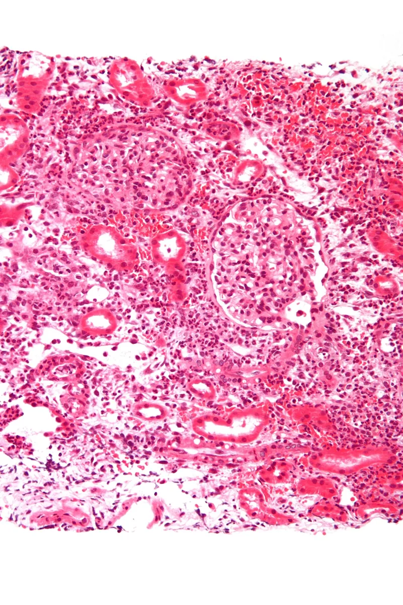 Acute pyelonephritis – Histology in acute pyelonephritis: dense neutrophilic infiltrate in the interstitium and tubules