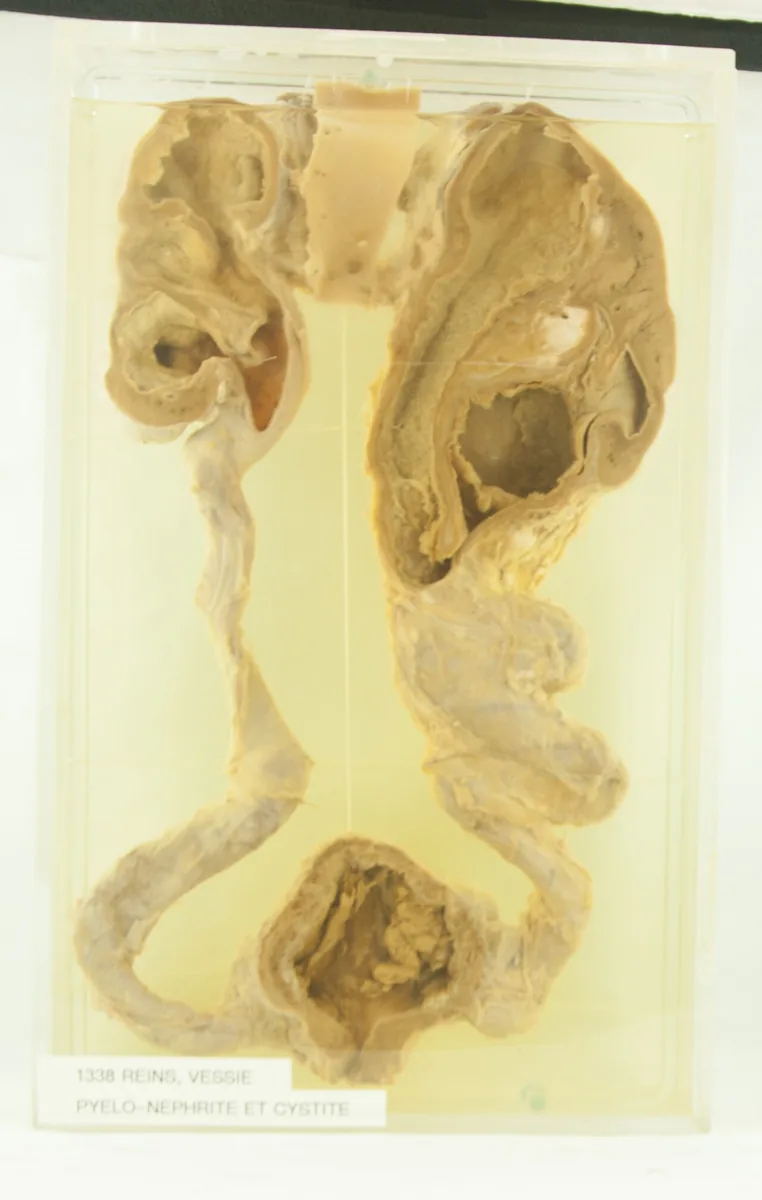 Acute pyelonephritis – gross specimen: Museum specimen of both kidneys, ureters and bladder in ascending pyelonephritis with cystitis: dilated renal pelves, tortuous ureters