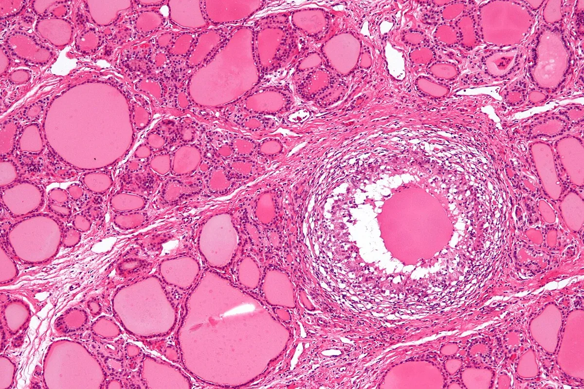 Subacute thyroiditis (de Quervain) – Histology of subacute thyroiditis (H&E): granulomatous inflammation with multinucleated giant cells around destroyed follicles