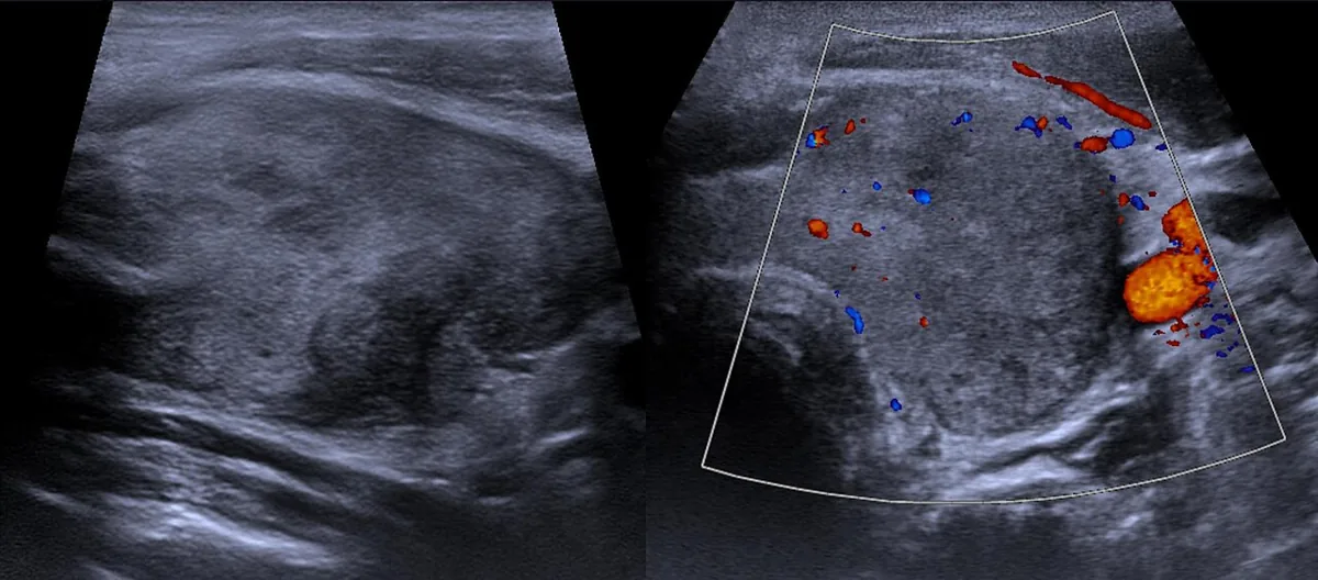 Subacute thyroiditis (de Quervain) – Ultrasound in de Quervain's thyroiditis: ill-defined, map-like hypoechoic areas in the thyroid lobe