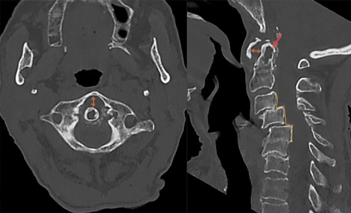 Rheumatoid arthritis – CT of the cervical spine (axial/sagittal, annotated): widened atlanto-dental interval, malalignment of the vertebral bodies and erosions of the dens