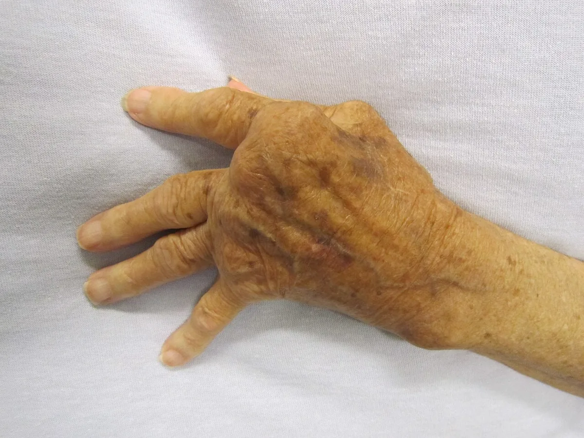 Rheumatoid arthritis – clinical photo: Hand in rheumatoid arthritis: ulnar deviation of the fingers and swelling of the MCP joints