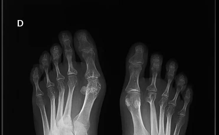 Rheumatoid arthritis – X-ray of both forefeet: erosions and malalignment of the MTP joints in rheumatoid arthritis
