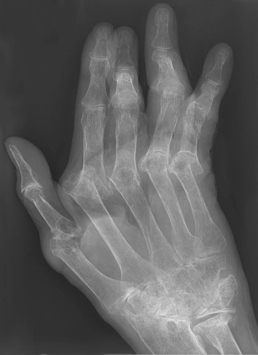 Rheumatoid arthritis – Hand X-ray (AP): erosions and joint space narrowing at the carpus and MCP joints, subluxations with ulnar deviation of the fingers