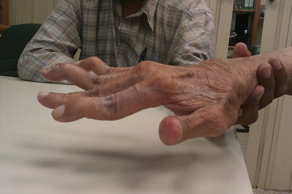 Rheumatoid arthritis – clinical photo: Swan-neck deformity of the fingers: hyperextension at the PIP joint and flexion at the DIP joint