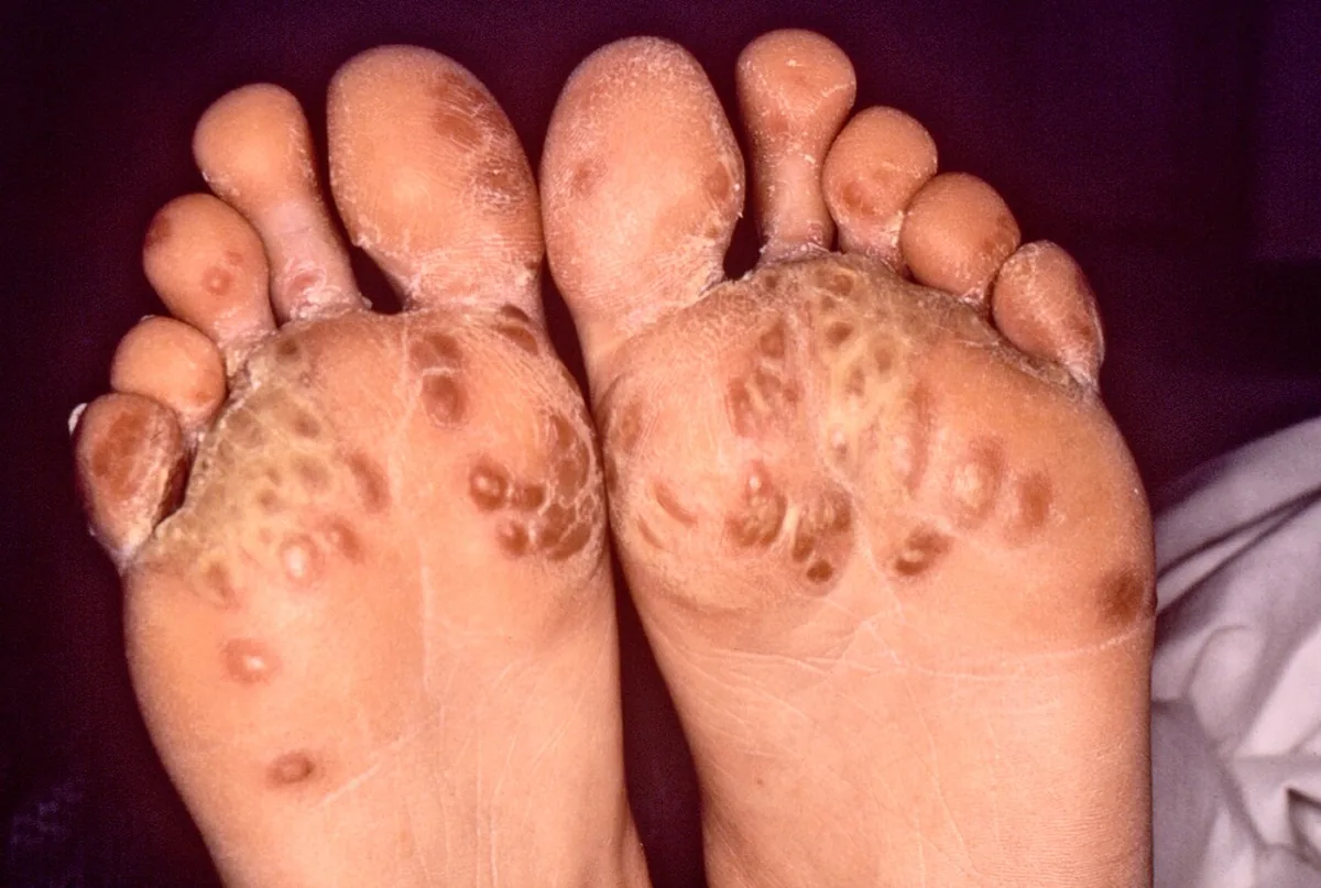Reactive arthritis – foot – clinical photo: Keratoderma blennorrhagicum: brownish, scaly-crusted hyperkeratoses on both soles