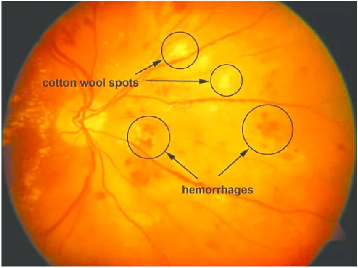 Diabetic retinopathy – Fundus photo in diabetic retinopathy with labelled cotton wool spots and retinal hemorrhages