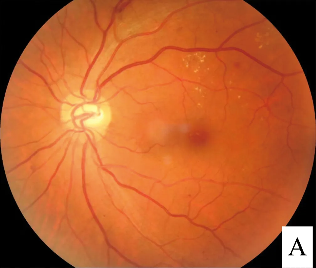 Diabetic retinopathy – Fundus photo in diabetic retinopathy: hard exudates, microaneurysms and small retinal hemorrhages