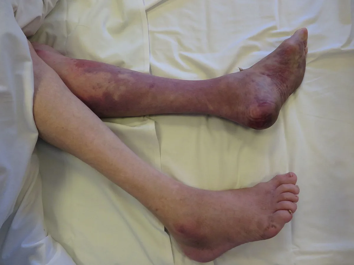 Rhabdomyolysis – clinical photo: Legs after prolonged compression (crush syndrome): livid discoloration and skin bleeding over the compressed muscle areas