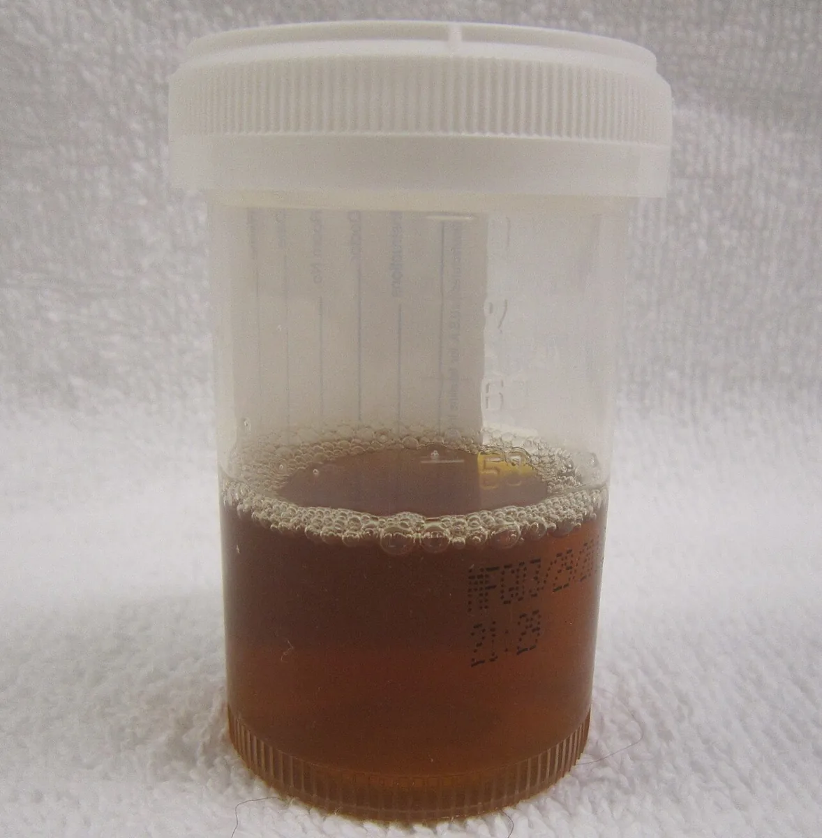 Rhabdomyolysis – clinical photo: Urine sample in rhabdomyolysis: dark brown, cola-colored urine due to myoglobinuria