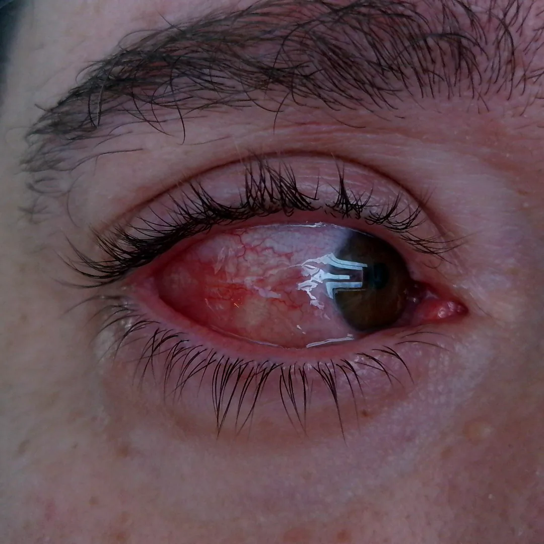 Allergic rhinitis (hay fever) – clinical photo: Acute allergic conjunctivitis with marked conjunctival swelling: glassy, edematous, bulging red conjunctiva