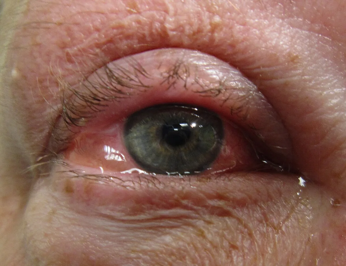 Allergic rhinitis (hay fever) – clinical photo: Allergic rhinoconjunctivitis: red conjunctiva, tearing and swollen eyelids