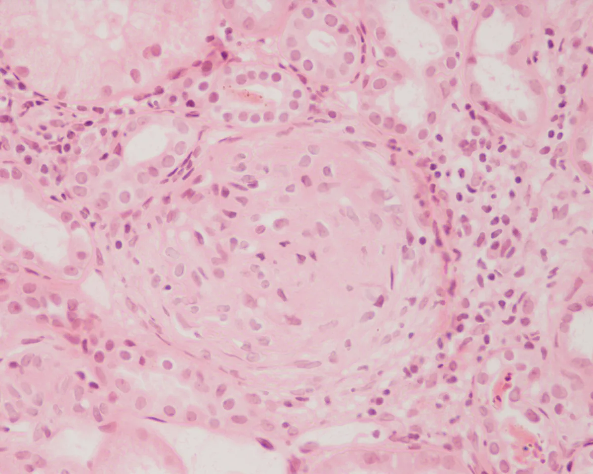 Rapidly progressive glomerulonephritis (RPGN) – Histology (H&E) in rapidly progressive GN: cellular crescent filling Bowman's space and compressing the capillary tuft