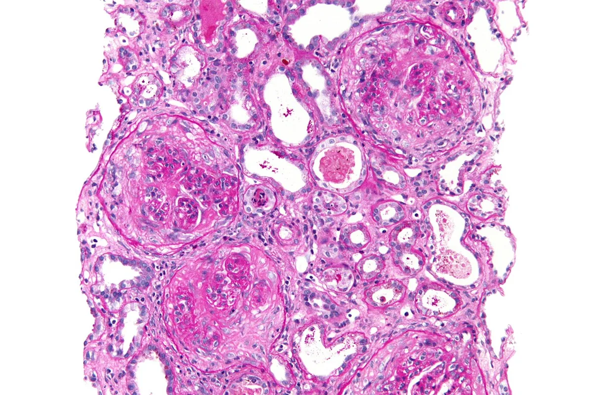 Rapidly progressive glomerulonephritis (RPGN) – histology: Kidney biopsy (PAS): several glomeruli with crescents in Bowman's capsule