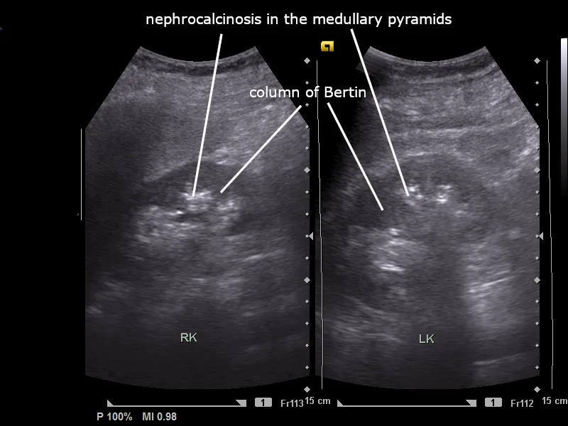Renal tubular acidosis – Ultrasound of both kidneys: echogenic medullary pyramids in medullary nephrocalcinosis (labelled)