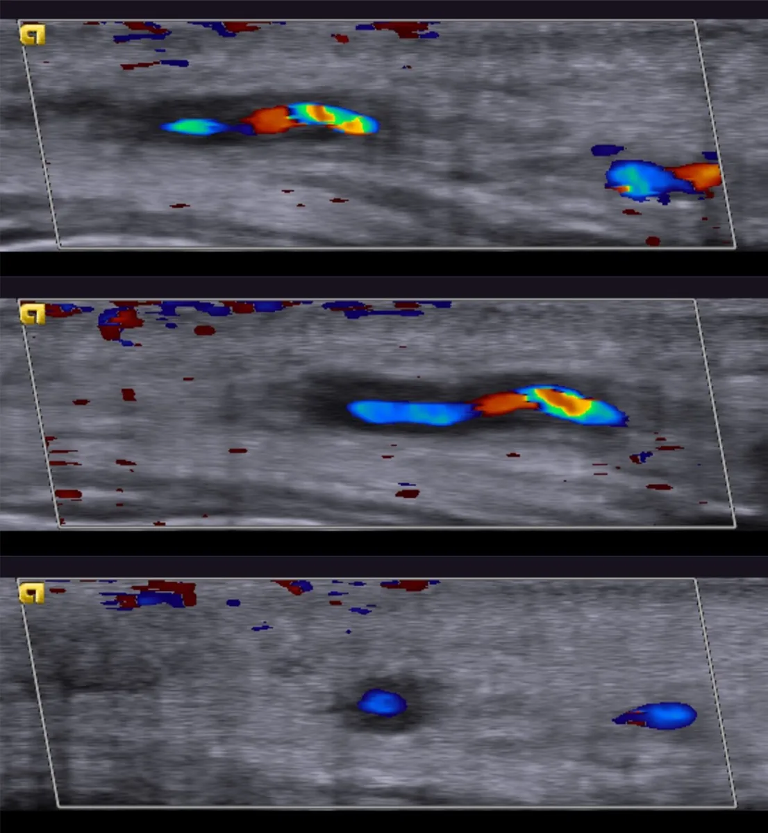 Giant cell arteritis (temporal arteritis) – ultrasound image: Color duplex of the temporal artery: hypoechoic wall thickening around the perfused lumen (halo sign) in long and short axis