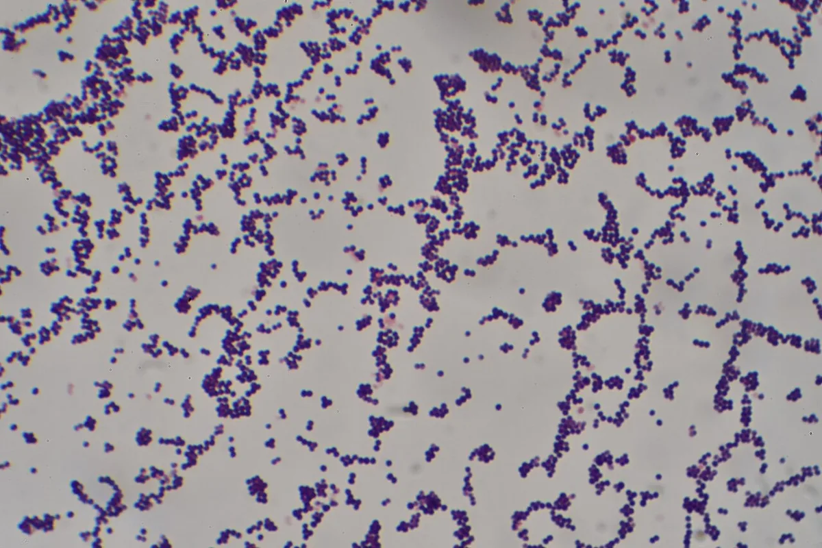 Staphylococcus aureus bacteremia – blood smear/cytology: Gram stain: Gram-positive (purple) cocci in grape-like clusters – the typical appearance of Staphylococcus aureus