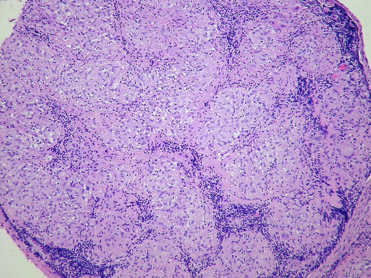 Sarcoidosis – Histology (H&E): mediastinal lymph node almost entirely replaced by uniform, non-necrotizing epithelioid granulomas