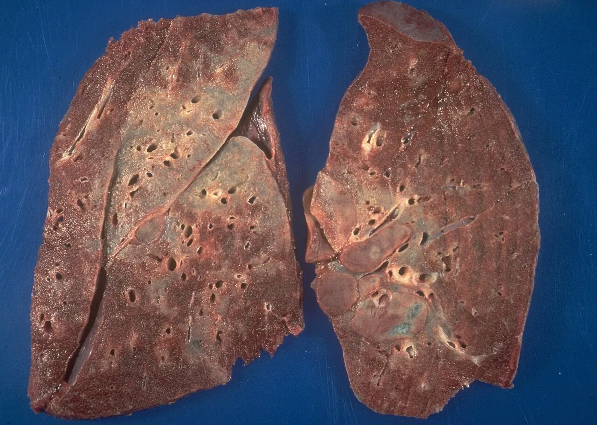 Sarcoidosis – Gross specimen: lung with confluent granulomas as grey-white consolidation and markedly enlarged hilar lymph nodes
