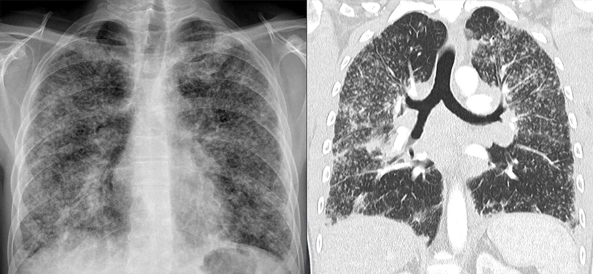 Sarcoidosis – Chest X-ray and coronal CT: pulmonary sarcoid with disseminated small nodules in both lungs, predominantly in the upper and middle zones