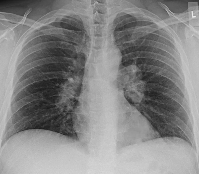 Sarcoidosis – Chest X-ray (PA): bilateral hilar lymphadenopathy, more pronounced on the left, without lung infiltrates