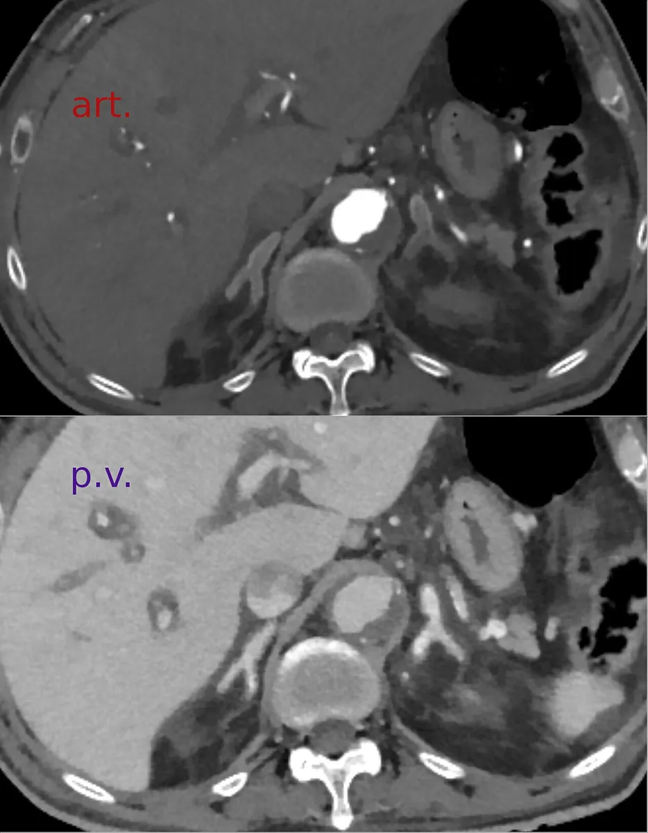 Shock (types of shock) – CT in circulatory shock (arterial and portal venous phase): conspicuously dense, hyperperfused adrenal glands and narrow contrast-filled vessels