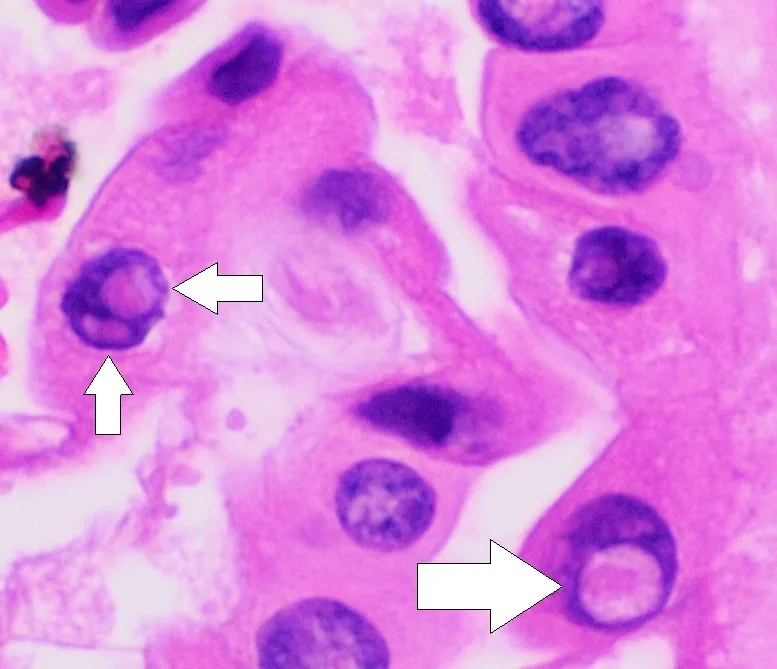 Thyroid cancer – Histology of papillary carcinoma (H&E, high power): ground-glass nuclei with nuclear grooves and intranuclear inclusions (arrows)