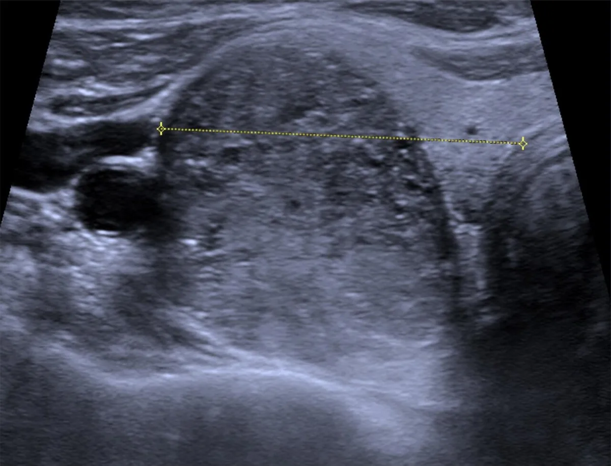 Thyroid cancer – Thyroid ultrasound: hypoechoic, ill-defined nodule in papillary thyroid carcinoma