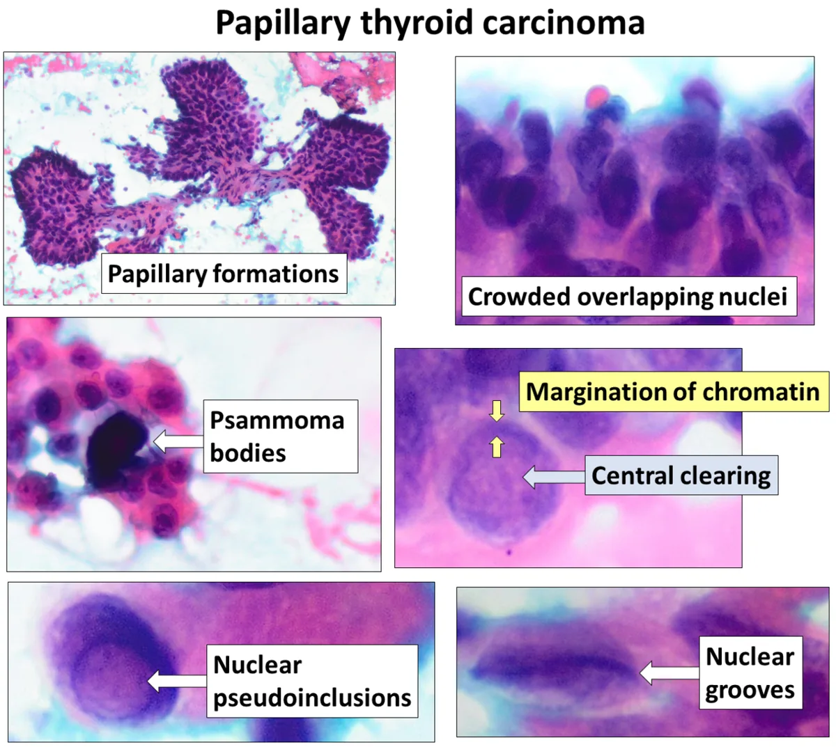Thyroid cancer – Fine-needle cytology in papillary carcinoma (labelled): papillary clusters, overlapping nuclei, grooves, pseudoinclusions, psammoma bodies