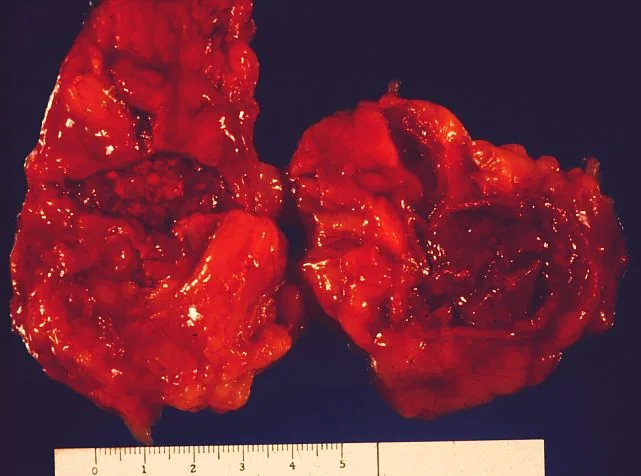 Sepsis and septic shock (blood poisoning) – gross specimen: Autopsy specimen: bilateral hemorrhagic necrosis of the adrenal glands (Waterhouse-Friderichsen syndrome) in fulminant sepsis