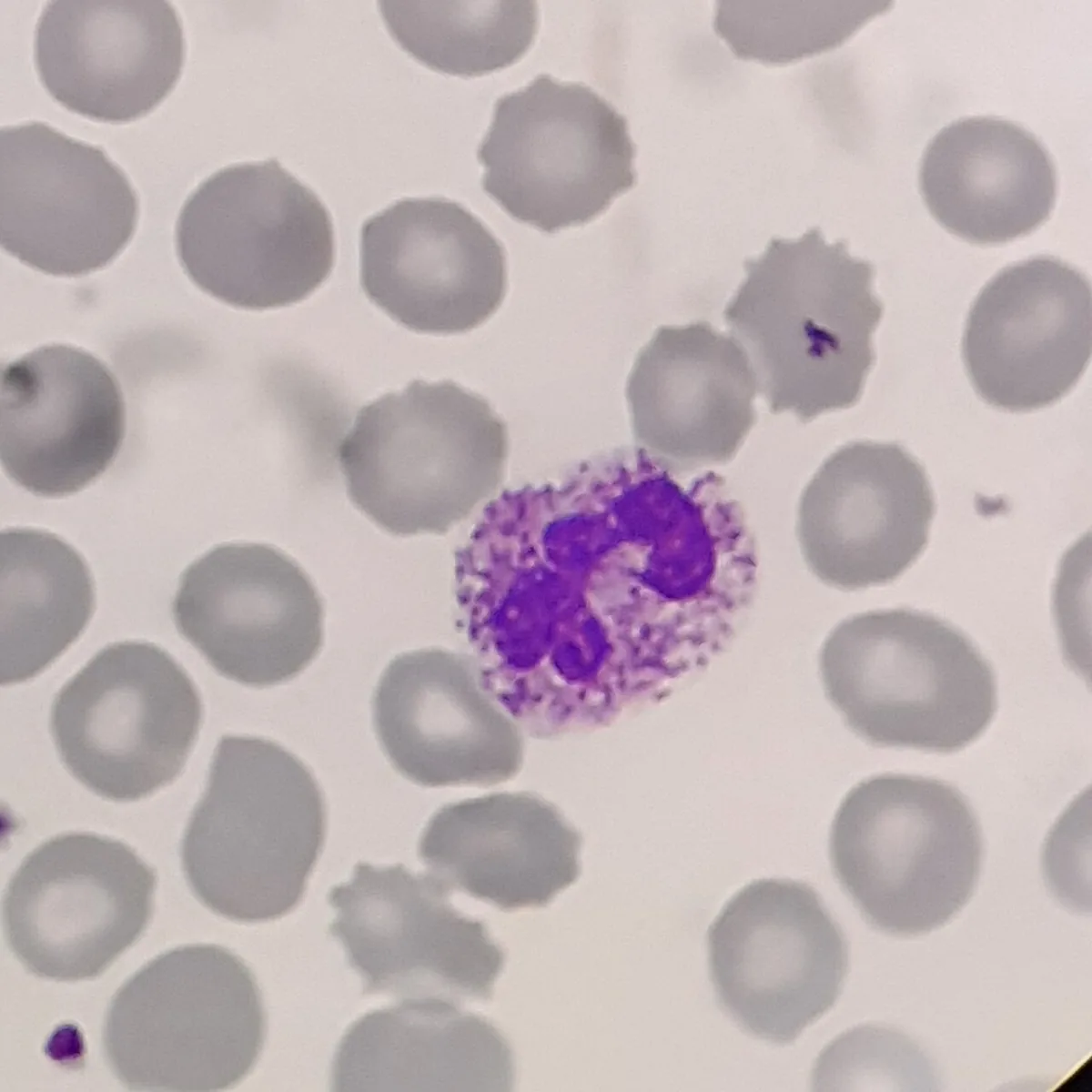 Sepsis and septic shock (blood poisoning) – Blood smear: segmented neutrophil with coarse, dark toxic granulation in bacterial infection