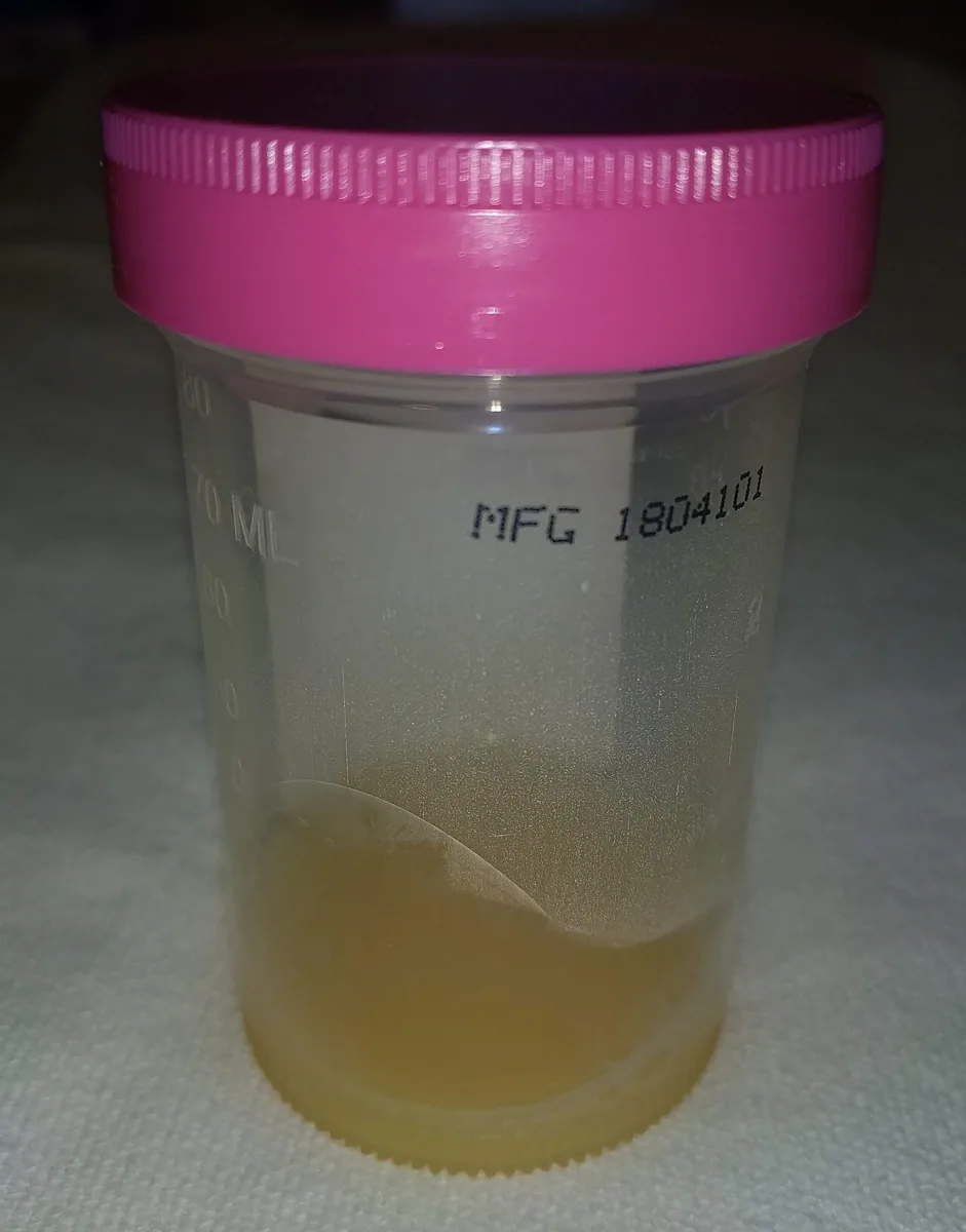 Septic arthritis – clinical photo: Joint aspirate in septic arthritis: turbid, yellowish purulent synovial fluid in a specimen container