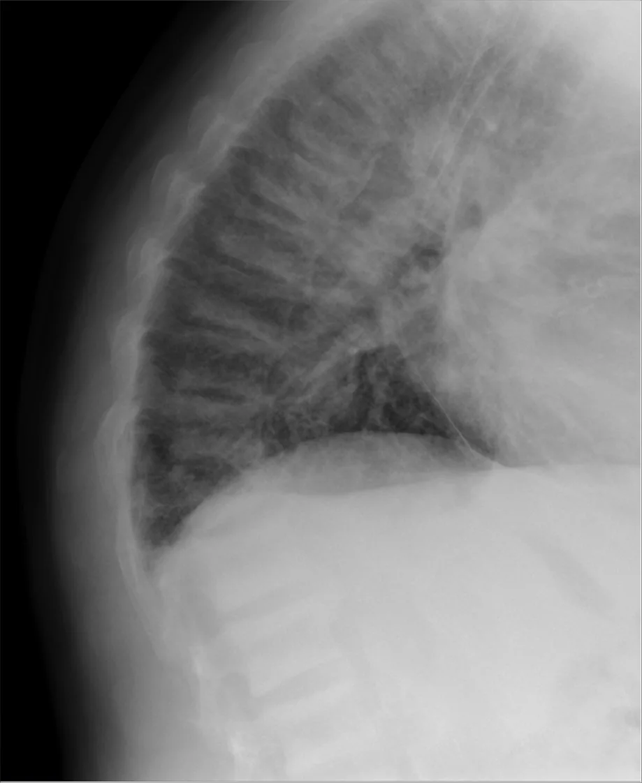 Secondary hyperparathyroidism – Lateral X-ray: rugger-jersey spine with band-like sclerosis of the vertebral endplates