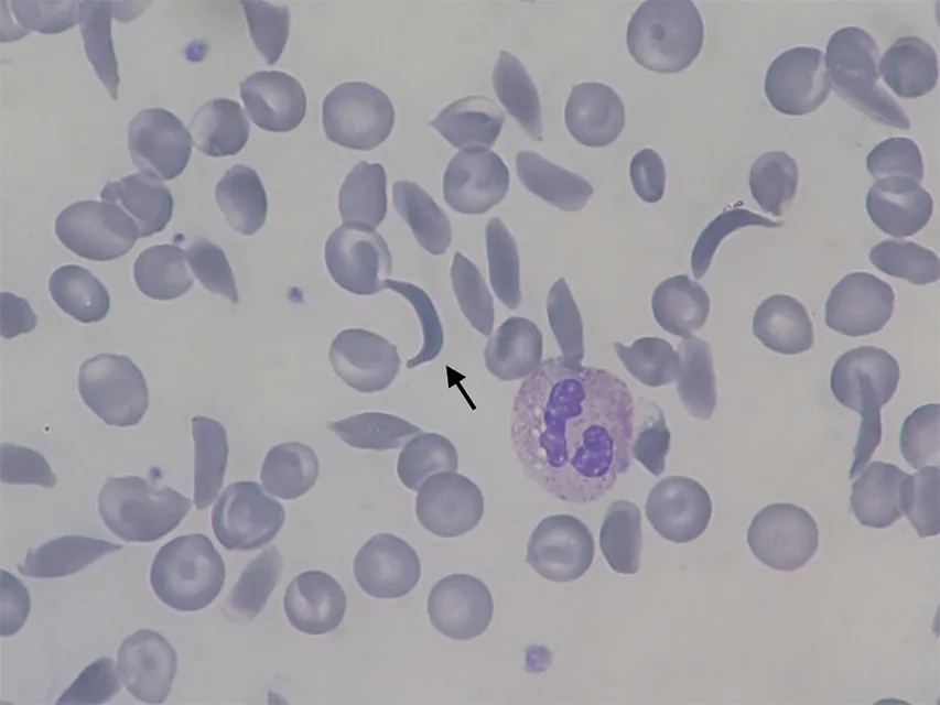 Sickle cell disease – Blood smear: several elongated sickle cells (arrow) next to normally shaped red cells