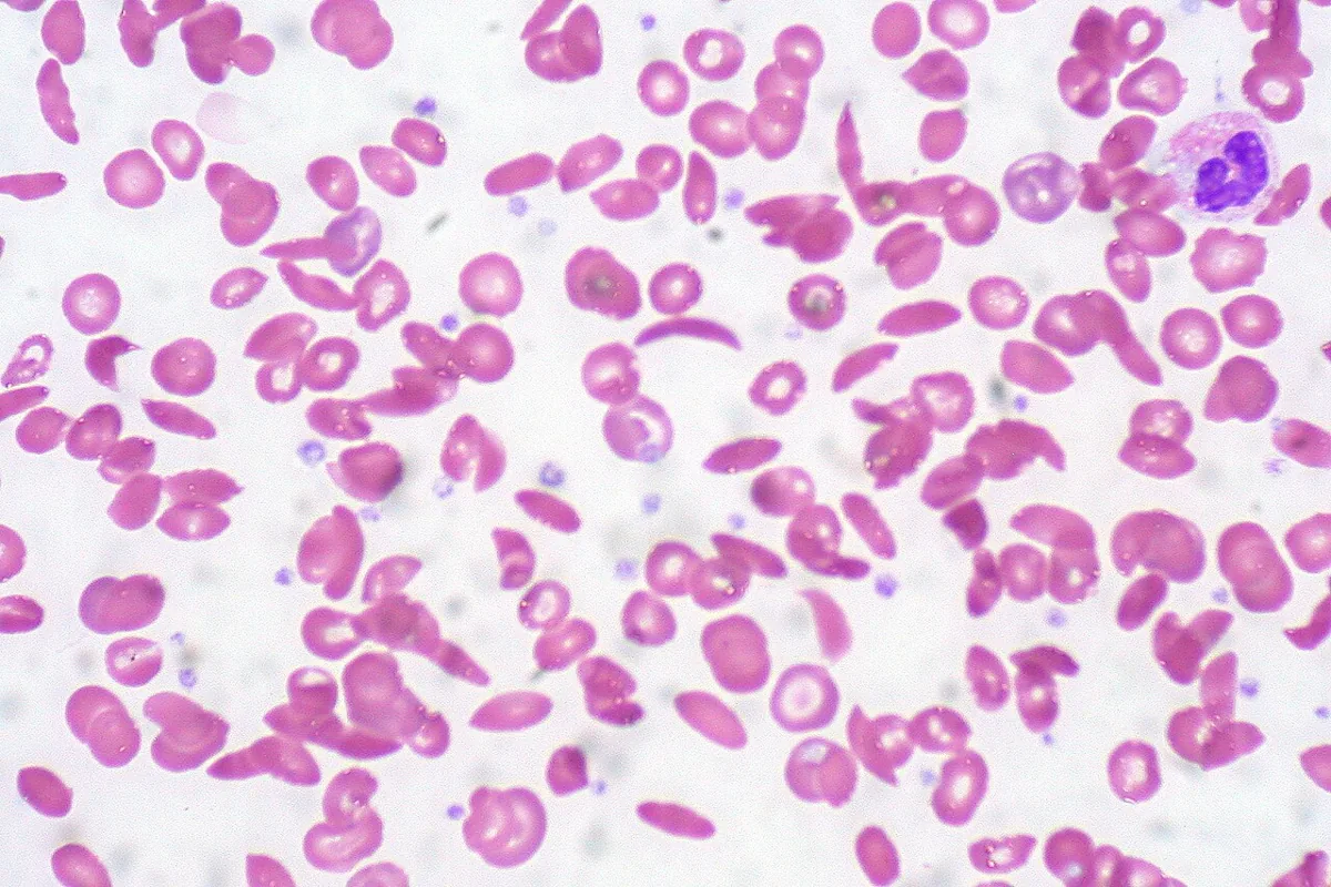 Sickle cell disease – Blood smear in sickle cell disease: numerous sickle-shaped red cells (drepanocytes) and codocytes
