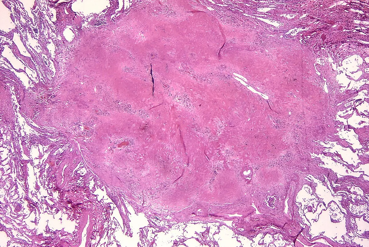 Silikose – Histologie (HE): silikotisches Knötchen aus konzentrisch geschichtetem, zellarmem Kollagen (noduläre Fibrose)