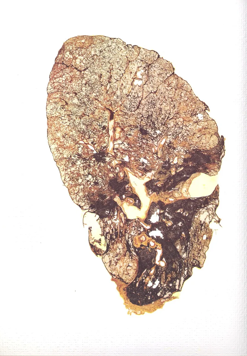 Silikose – Makropräparat: Ganzlungenschnitt: Silikose mit dunkel pigmentierten, konfluierenden fibrotischen Schwielen (progressive massive Fibrose)