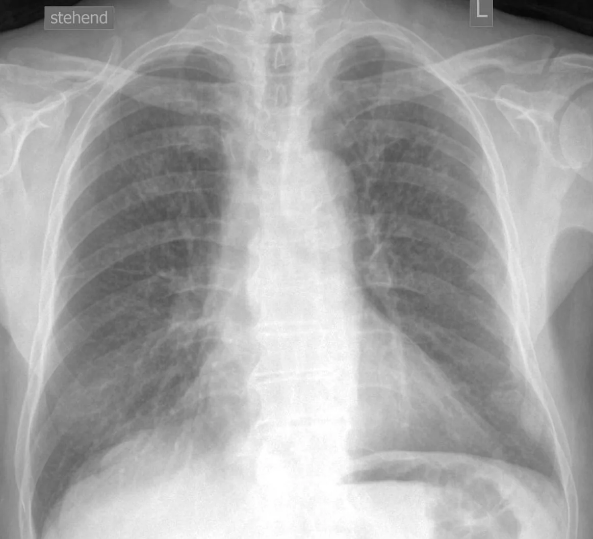 Silikose – Röntgen-Thorax p.a.: Silikose mit multiplen kleinnodulären Verdichtungen beider Lungen; nebenbefundlich alte Rippenfrakturen links