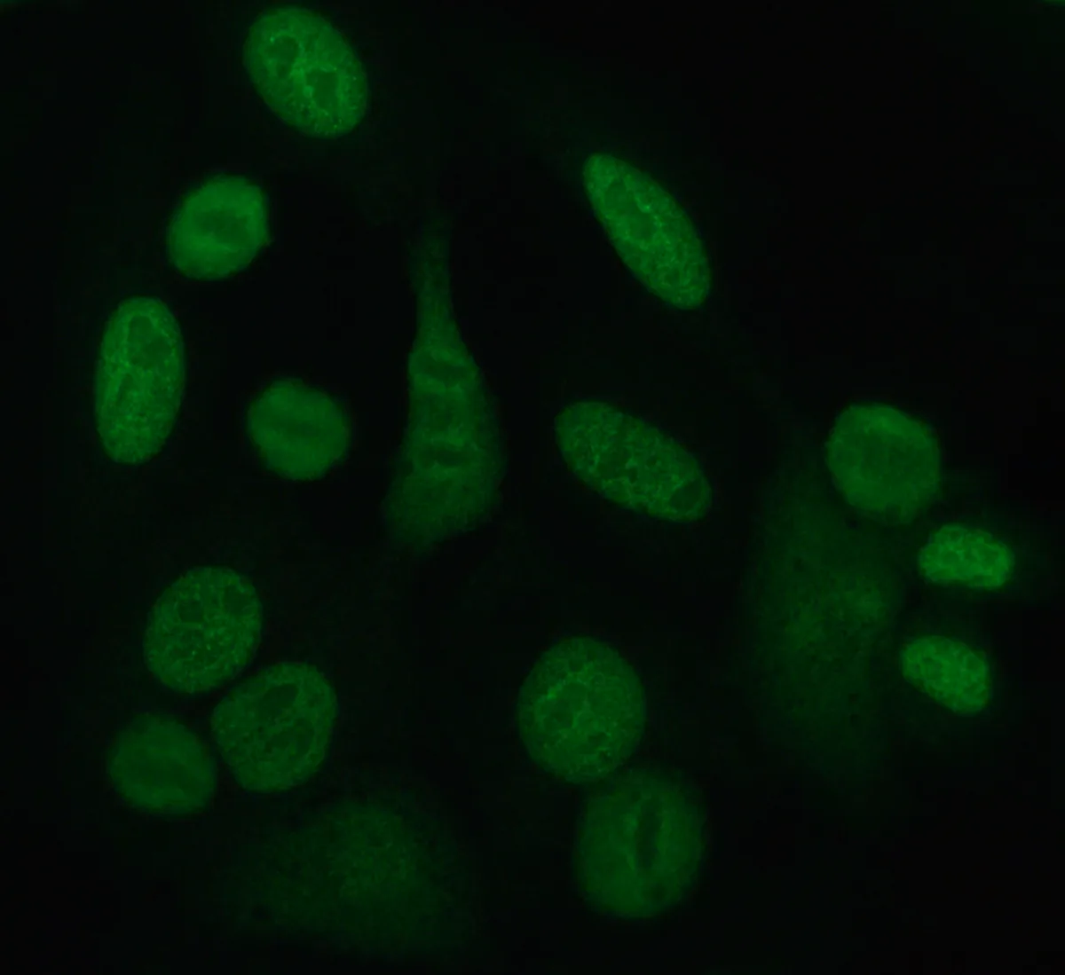 Sjögren's syndrome – Indirect immunofluorescence on HEp-2 cells: fine speckled nuclear pattern as seen with SSA/Ro and SSB/La antibodies