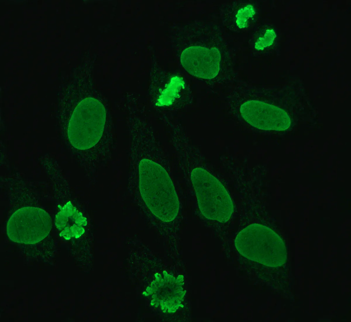Systemic lupus erythematosus (SLE) – Indirect immunofluorescence on HEp-2 cells: homogeneous nuclear pattern with stained chromosomes in mitoses (suggesting dsDNA antibodies)
