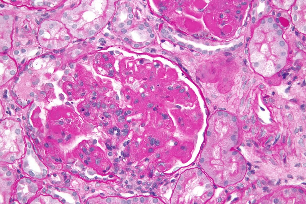 Systemic lupus erythematosus (SLE) – histology: Kidney biopsy (PAS) in diffuse proliferative lupus nephritis: hypercellular glomerulus with thickened capillary walls