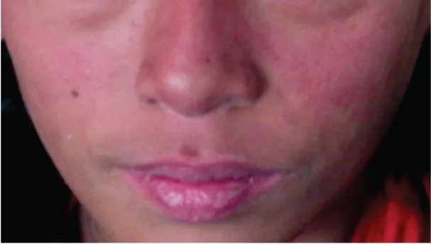 Systemic lupus erythematosus (SLE) – face – clinical photo: Butterfly (malar) rash: confluent redness over the cheeks and nasal bridge, sparing the nasolabial folds