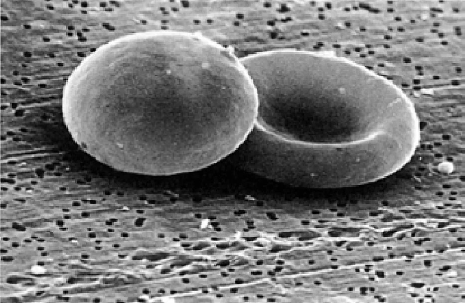 Hereditary spherocytosis – Scanning electron microscopy: spherical spherocyte (left) next to a normal biconcave red cell (right)