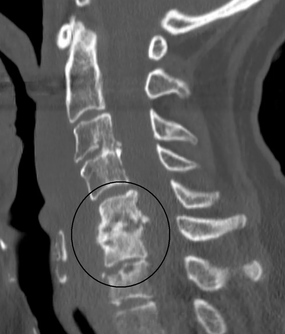 Spondylodiscitis – CT of the cervical spine (sagittal): destruction of the disc and adjacent vertebral endplates (circle) in infectious discitis
