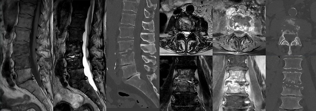 Spondylodiscitis – MRI (T1, T2, STIR, contrast-enhanced T1) and CT in L3/4 spondylodiscitis: signal change and enhancement of disc and adjacent vertebral bodies, endplate erosions