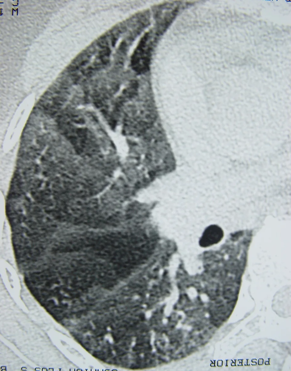 Systemic sclerosis (scleroderma) – CT scan: HRCT of the lung: basally predominant reticulation and ground-glass opacity in interstitial lung disease