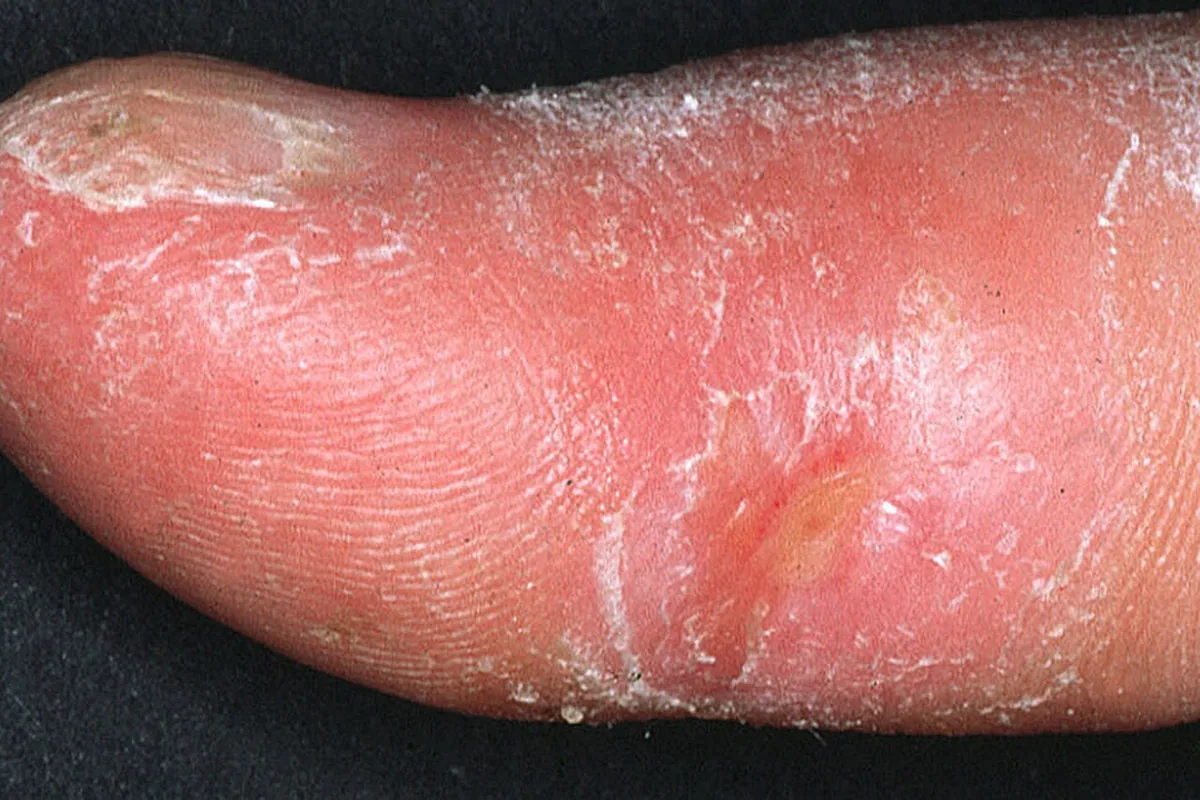Systemic sclerosis (scleroderma) – clinical photo: Finger in systemic sclerosis: tight, shiny skin and a small ulcer on the fingertip