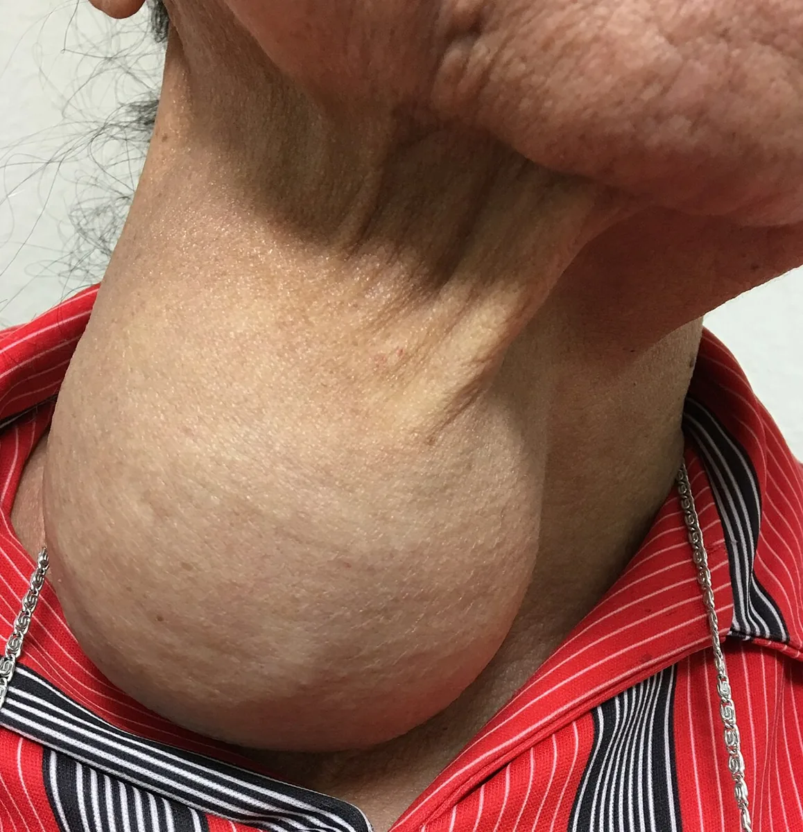 Goiter and thyroid nodules (goitre) – clinical photo: Large goiter: extensive, nodular-soft swelling of the anterior and lateral neck